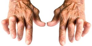 Diferența dintre artrită și artroză, pe înțelesul tuturor