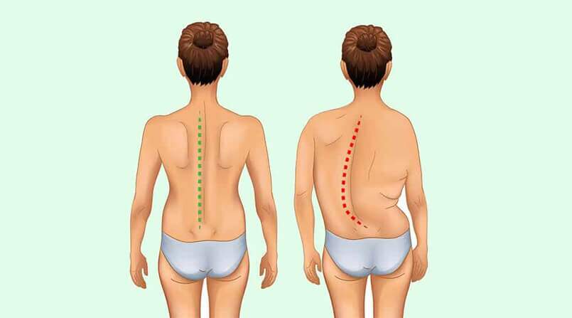 A osteopatia no tratamento da escoliose